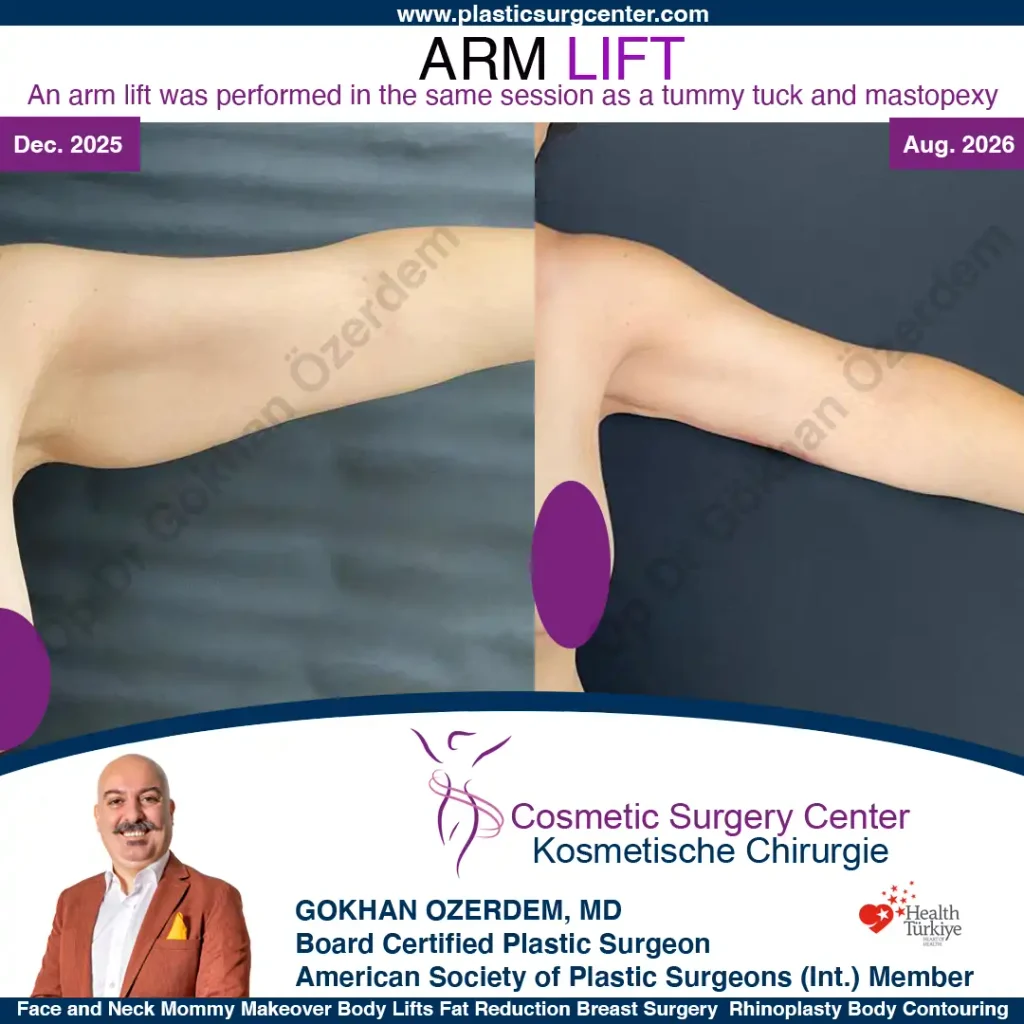 Oberarmstraffung – Vorher und Nachher, Fall 1, linker Arm