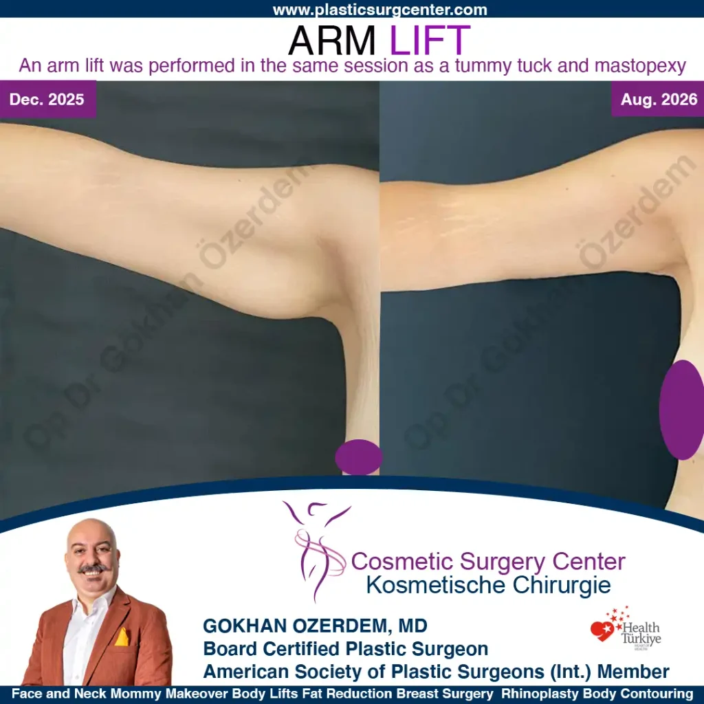 Oberarmstraffung – Vorher und Nachher, Fall 1, rechter Arm