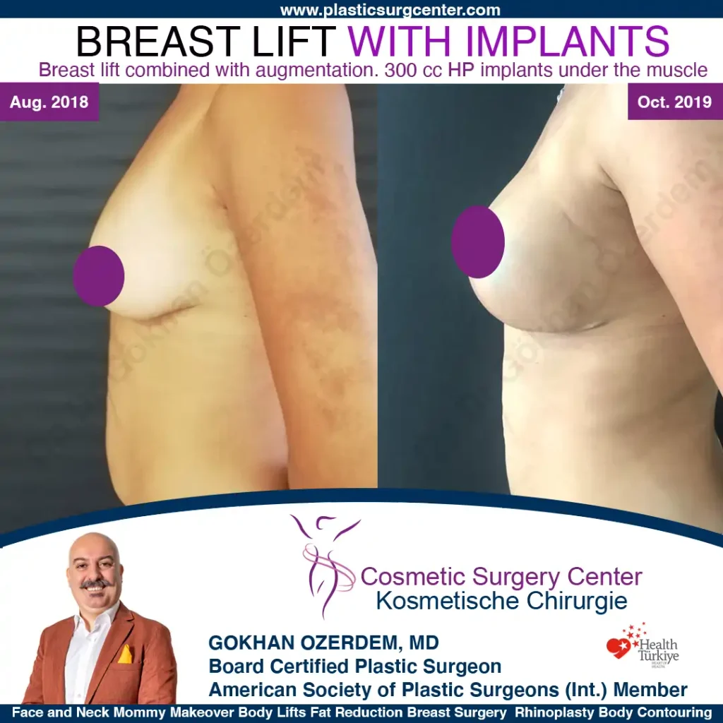 Bruststraffung – Vorher und Nachher, Fall 1, Bruststraffung mit Implantaten, Seitenansicht