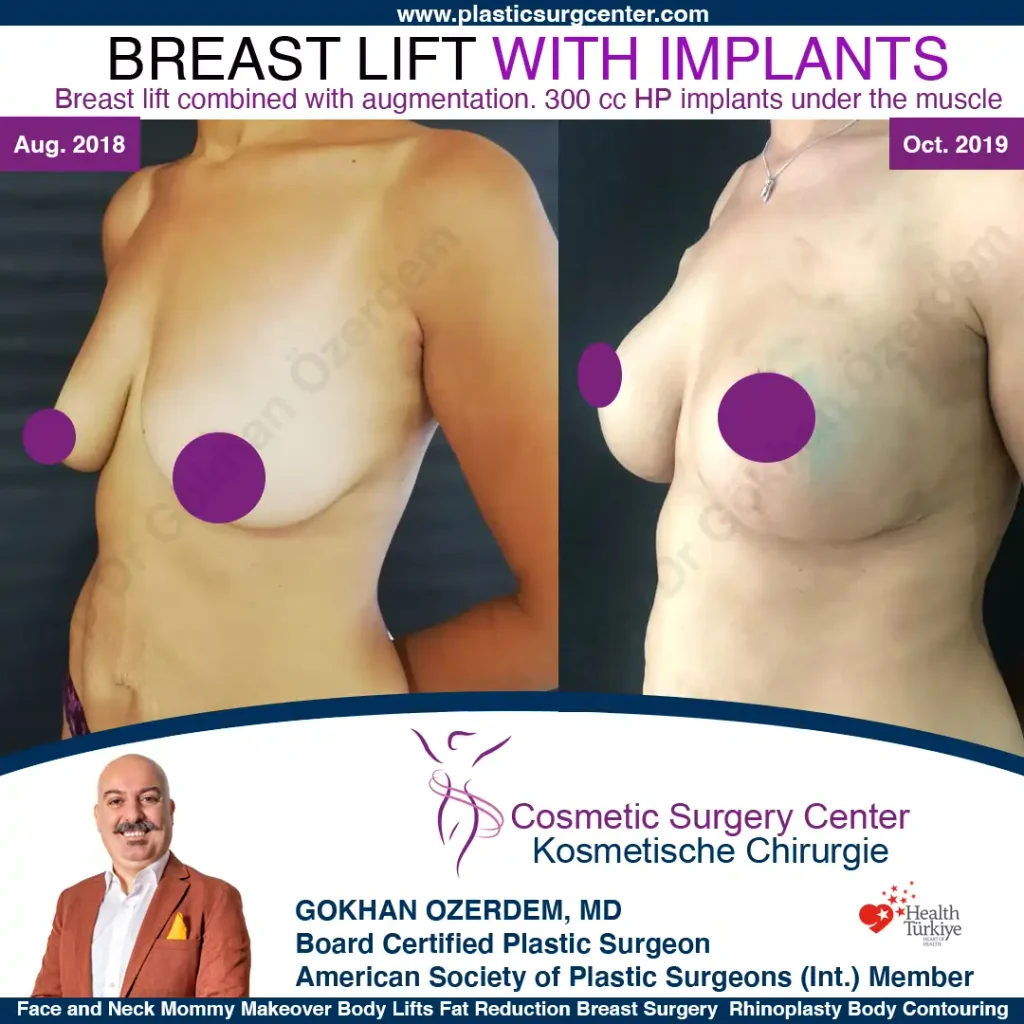 Bruststraffung – Vorher und Nachher, Fall 1, Bruststraffung mit Implantaten, schräge Ansicht