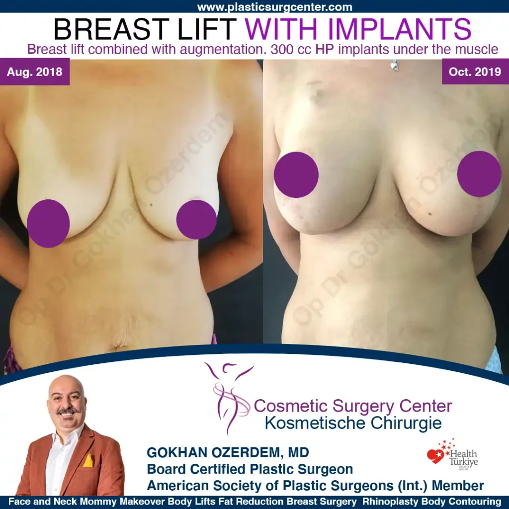 Bruststraffung – Vorher und Nachher, Fall 1, Bruststraffung mit Implantaten, Ansicht von vorne