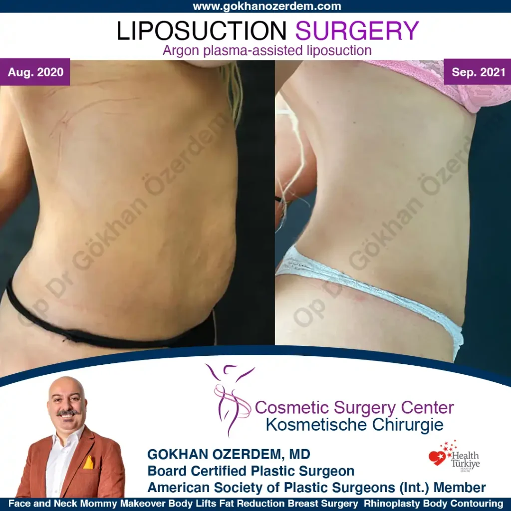 Fettabsaugung – Vorher und Nachher, Fall 1, rechte Seite