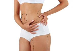 Fettabsaugung in Antalya – Liposuktion in der Türkei