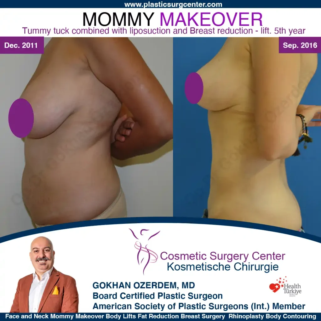 Mommy Makeover – Vorher und Nachher, Fall 1, Ansicht von der linken Seite