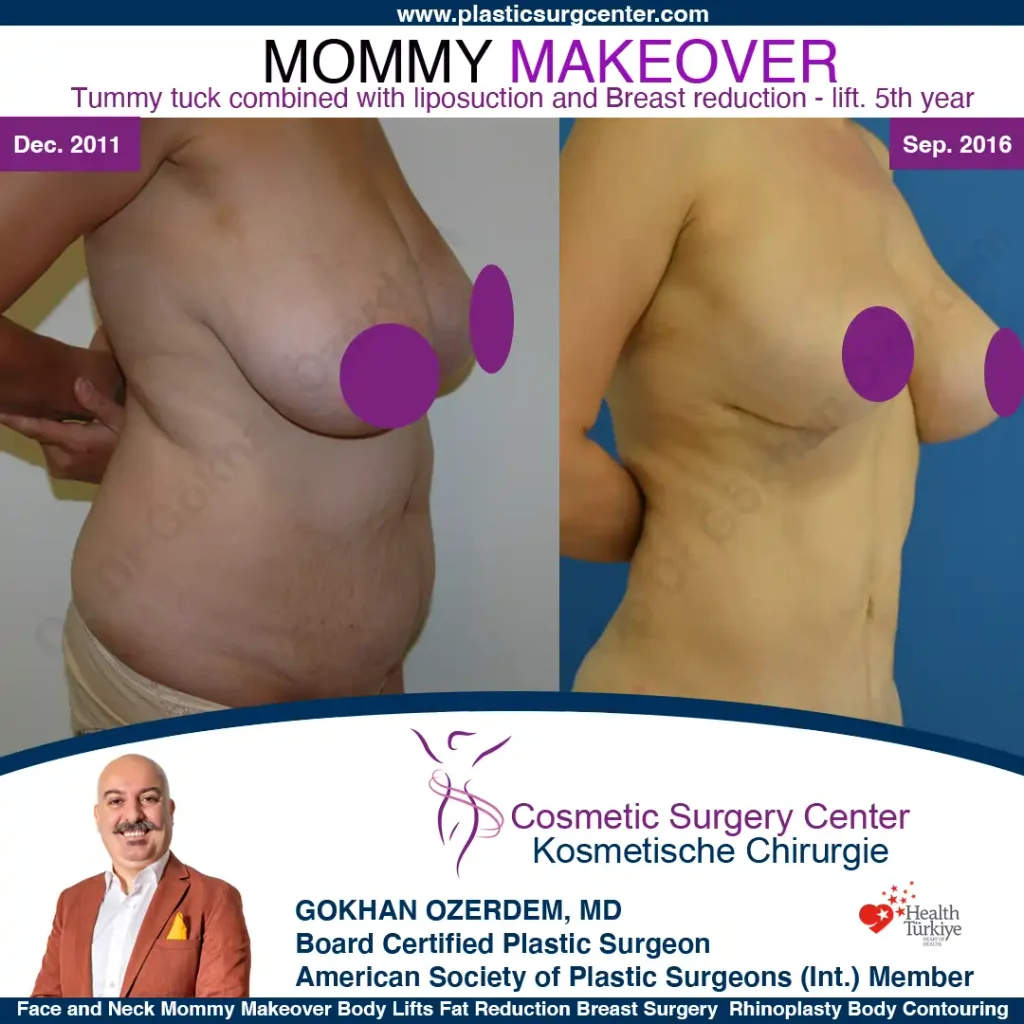 Mommy Makeover – Vorher und Nachher, Fall 1, Ansicht von rechts vorne
