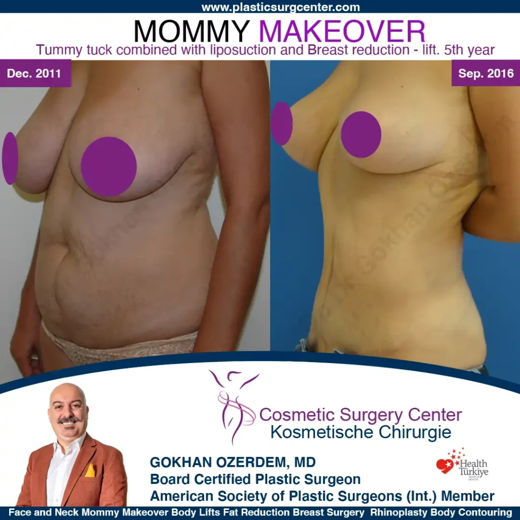 Mommy Makeover – Vorher und Nachher, Fall 1, Ansicht von schräg links