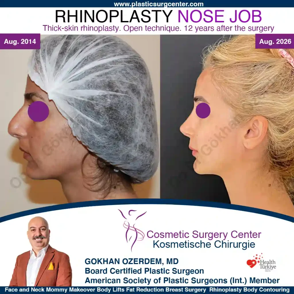 Rhinoplastik – Vorher und nachher, Fall 1: linkes Profil