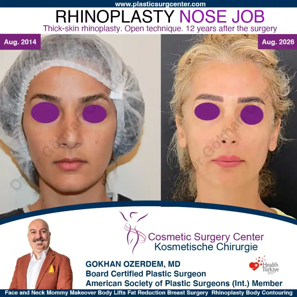 Rhinoplastik – Vorher und nachher, Fall 1: Ansicht von vorne