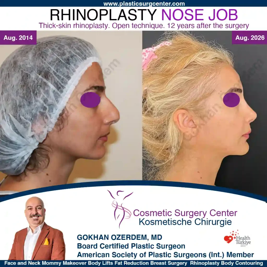 Rhinoplastik – Vorher und nachher, Fall 1: Rechtes Profil